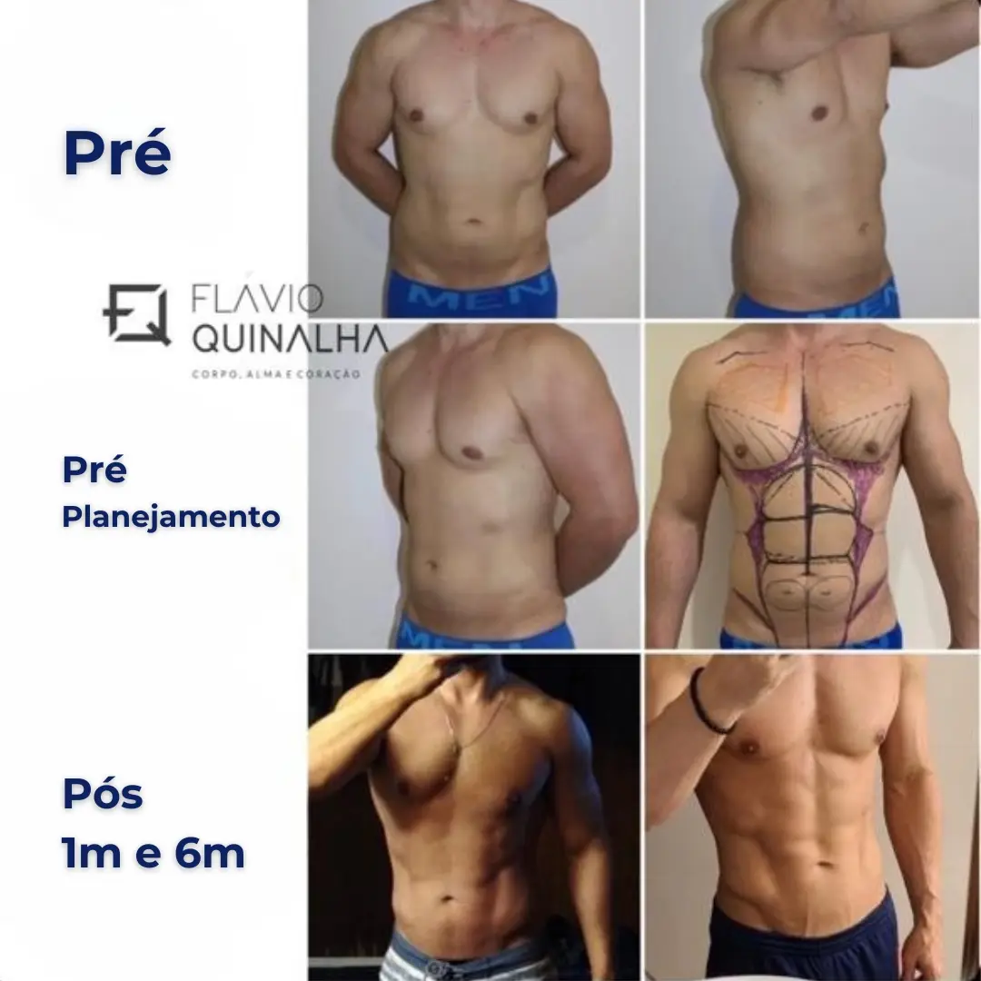 Sequência de um caso de lipo HD: antes, marcação do planejamento e depois com 1 e 6 meses