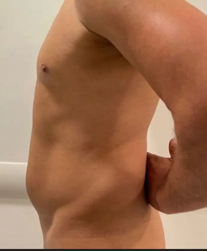 Antes, caso 15 · perfil